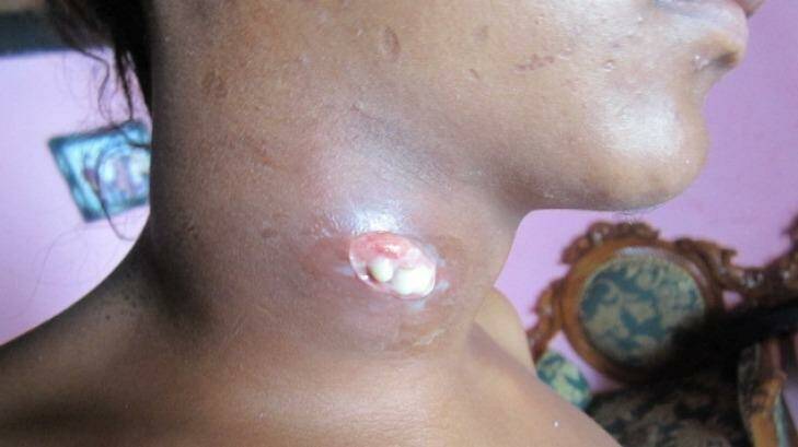 A West Timor local resident shows a neck cyst in 2011.  Photo: West Timor Care Foundation