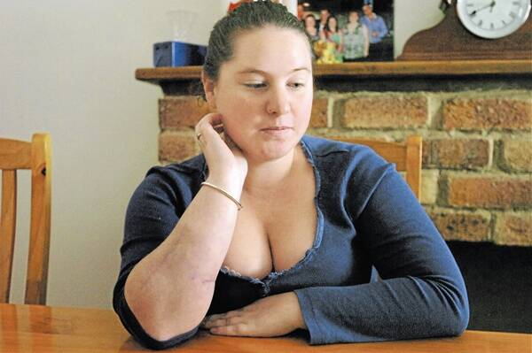 SCARRED: Rachel Hepworth is still recovering from a savage dog attack in February. 