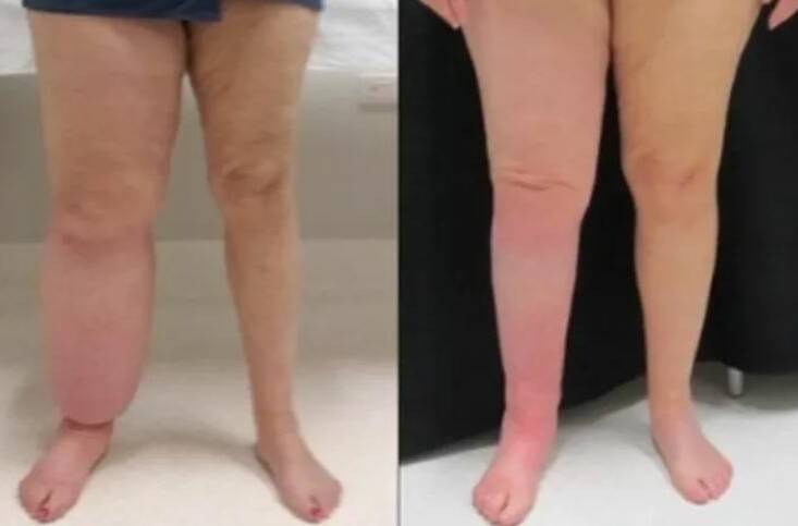 SUFFERING: A patient with lymphoedema in her right leg before and after treatment.