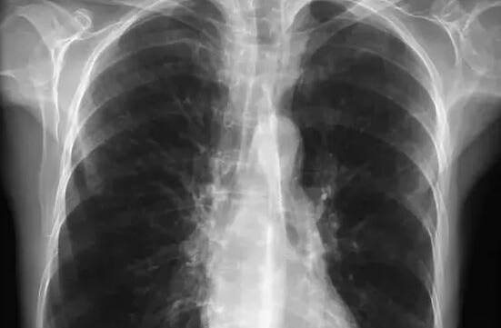 FATAL FLAW: The rate  of fatal lung disease in Orange is more than 55 per cent higher than the national average.
