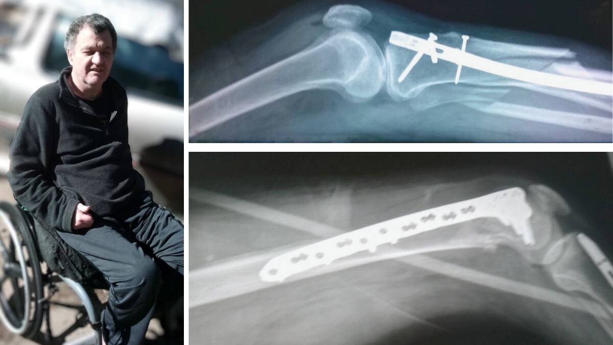 Jason Thorpe, with x-rays showing just some of the plates and pins his legs needed. Pictures supplied.