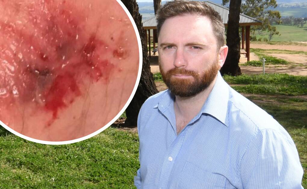 VERY PROUD: NSW Police Association representative Alex Christian, who was bitten while on duty as a police officer, has welcomed new legislation. 