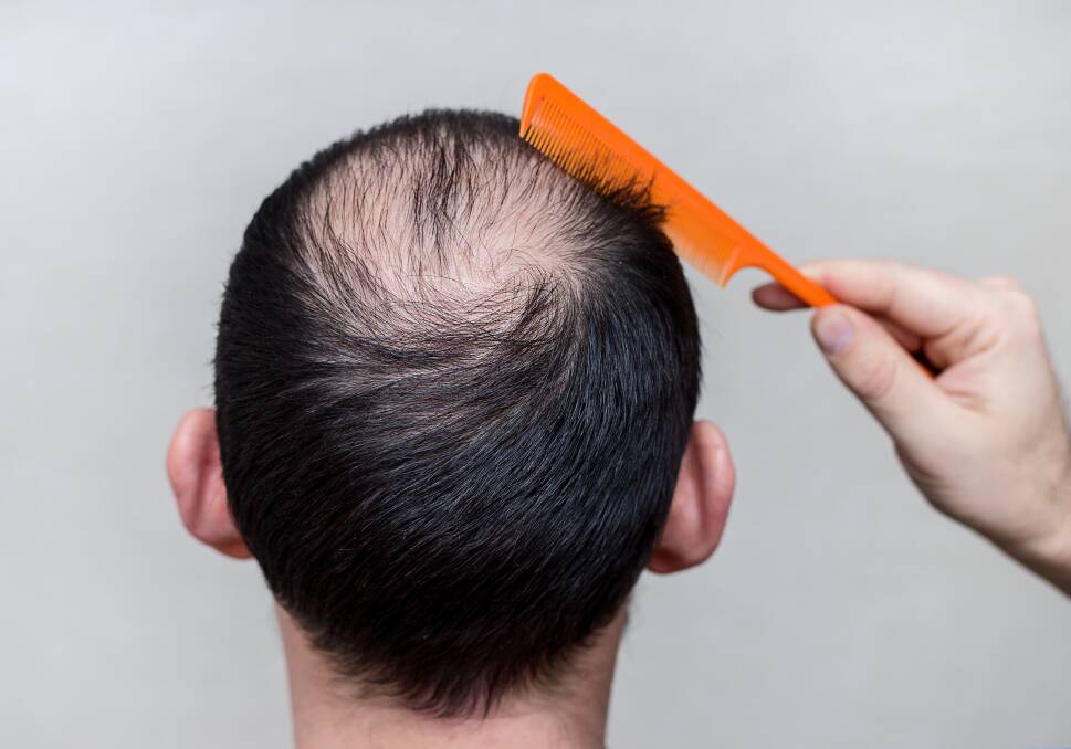 People may assume men do not care about their hair loss, but unfortunately, many men suffer from self-confidence issues around their balding appearance. Picture: Shuttertsock.